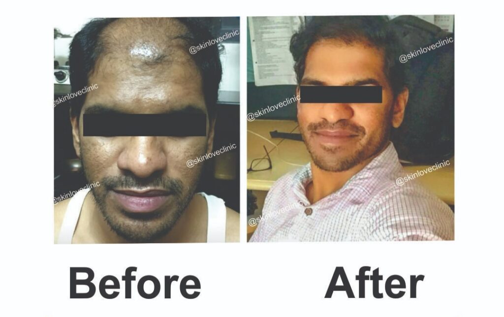 This image is about before and after of hair transplant