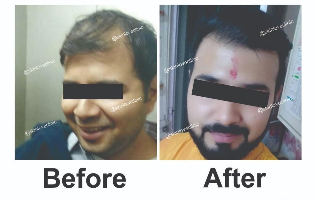 This image is about before and after of hair transplant