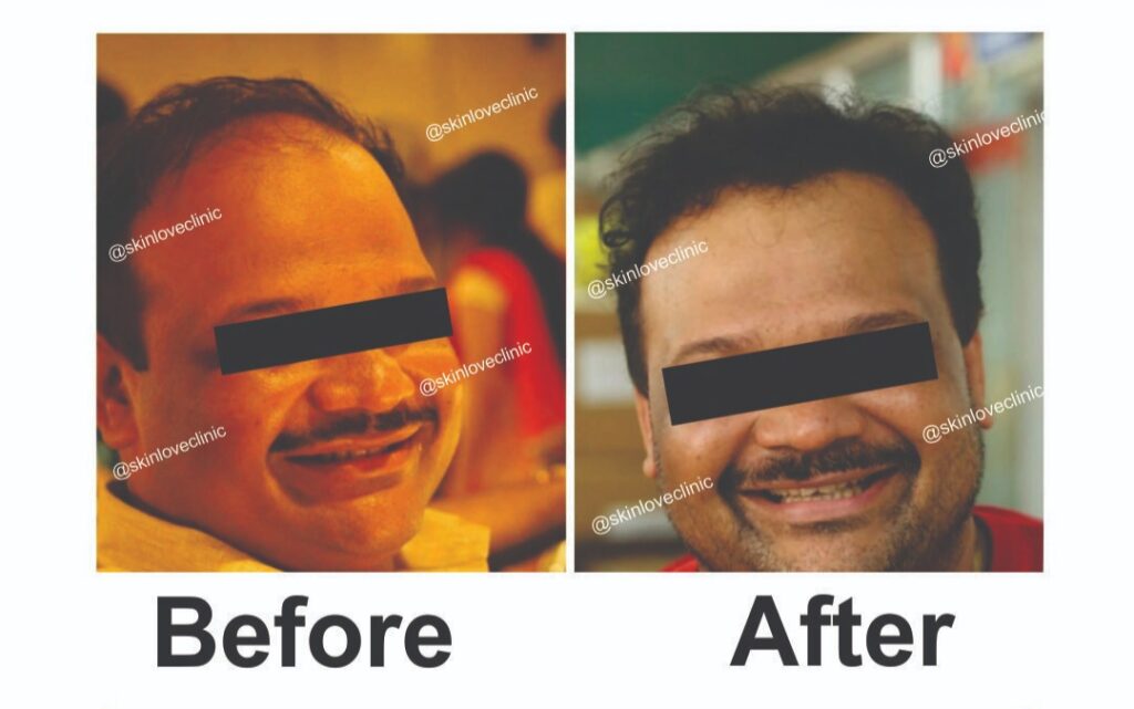 This image is about before and after of hair transplant