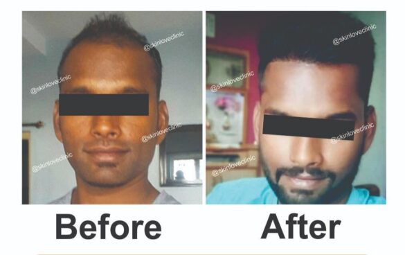 This image is about before and after of hair transplant