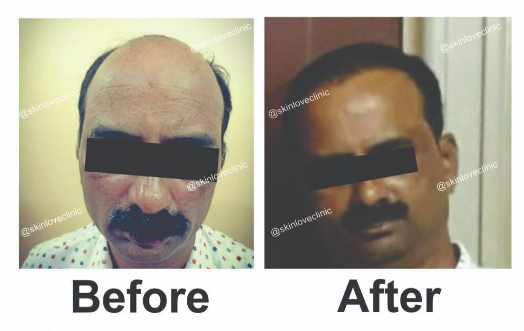 This image is about before and after of hair transplant