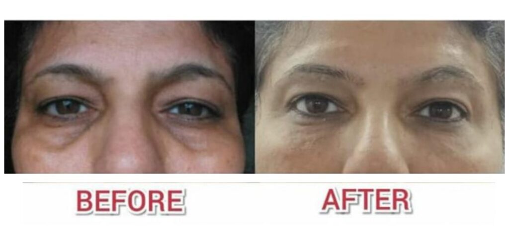 This Image tells us about the before and after of BOTOX for Worry Lines on Forehead treatment