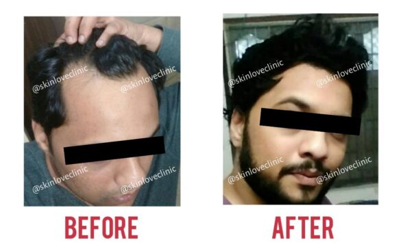 This Image tells us about the before and after of hair transplant