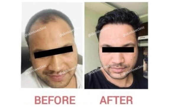 This image is about the before and after of hairtransplant.