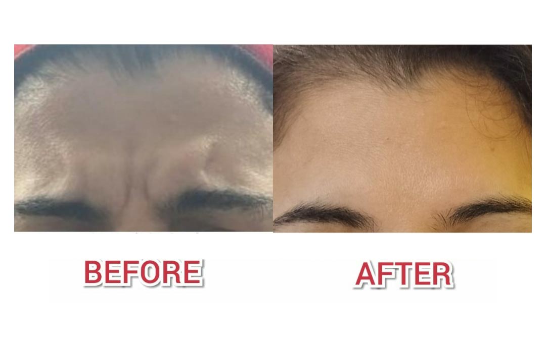 This image is about the before and after of a Face surgery.