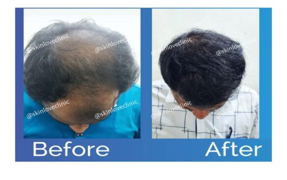 This image is about the before and after of hair transplant surgery.