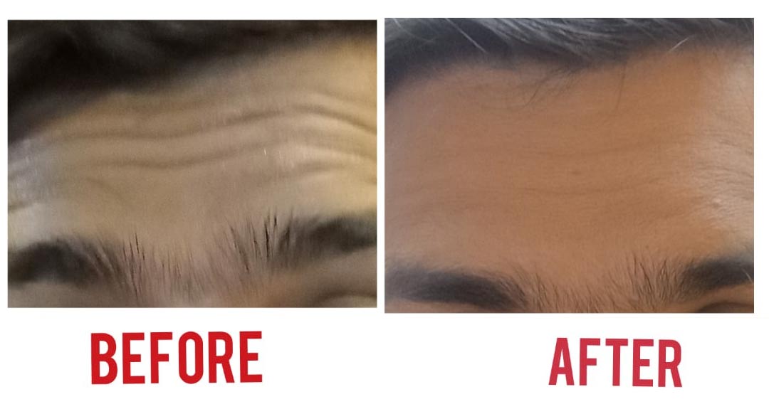 This Image tells us about the before and after of face treatment