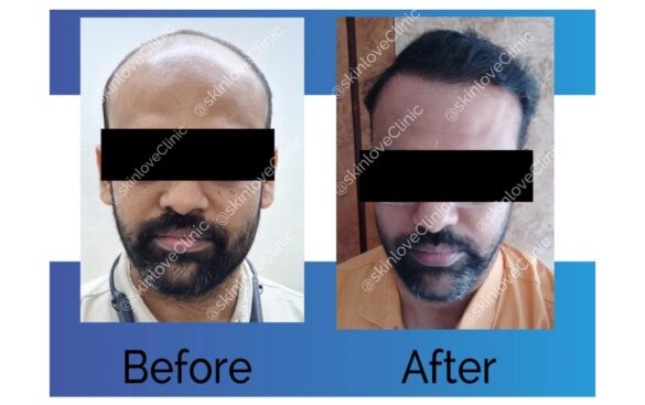 This Image tells us about the before and after of hair transplant