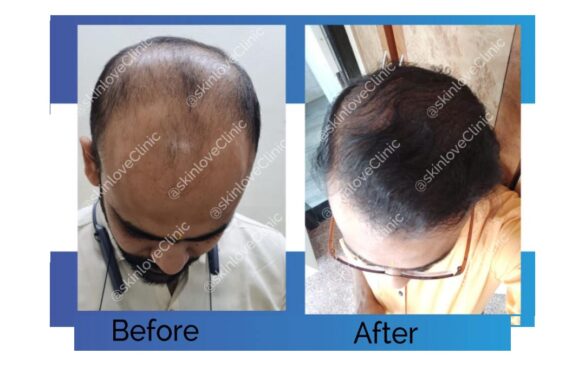 This Image tells us about the before and after of hair transplant