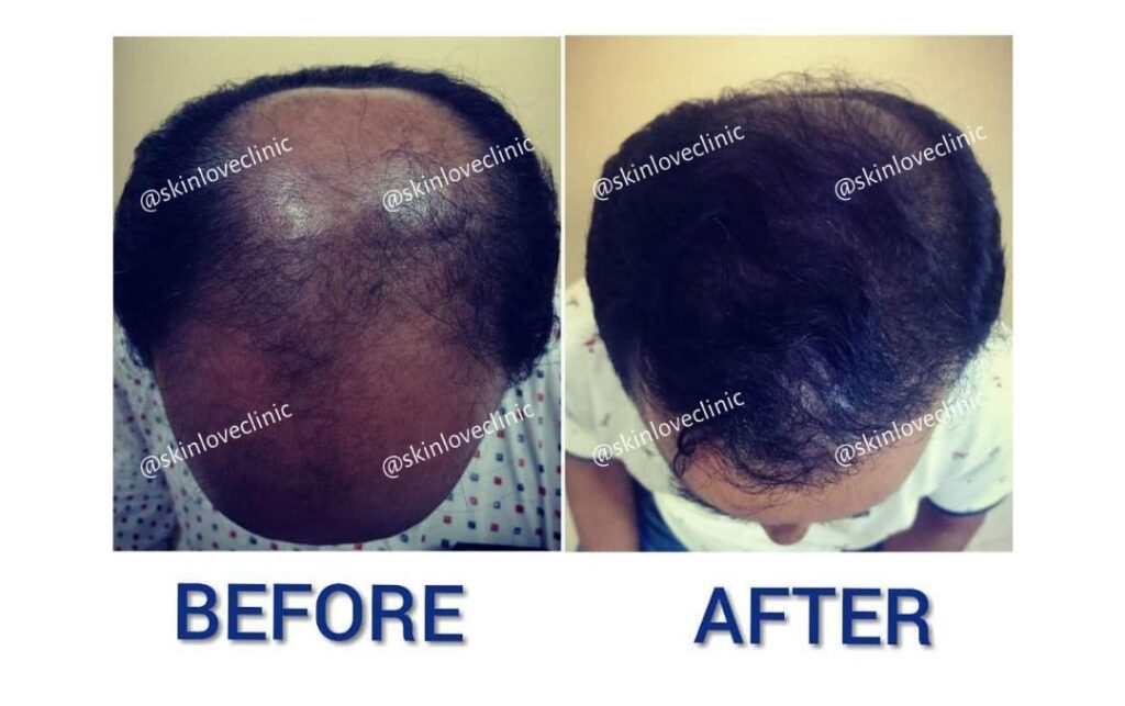 This Image tells us about the before and after of hair transplant