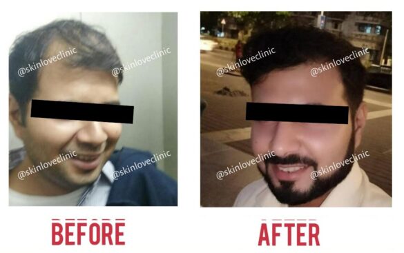 This Image tells us about the before and after of hair transplant