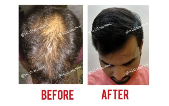 This Image tells us about the before and after of hair transplant