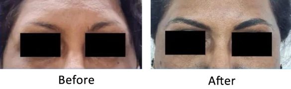 This Image tells us about the before and after the treatment