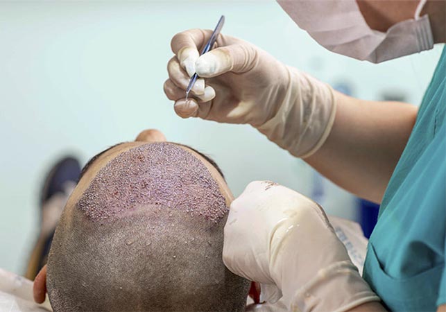 This image is about Hair Transplant in dadar