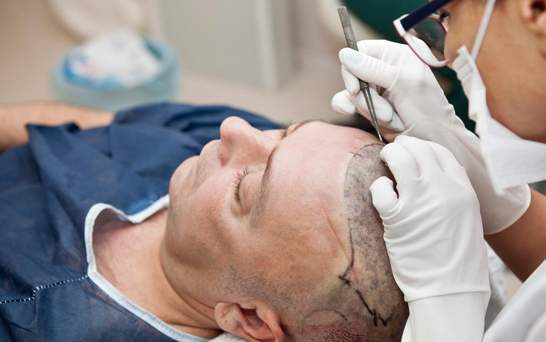 this image is about a man having a hair transplant