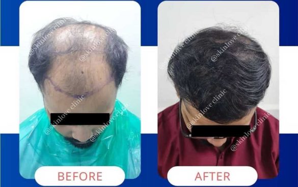 This Image tells us about the before and after of a hair transplant treatment