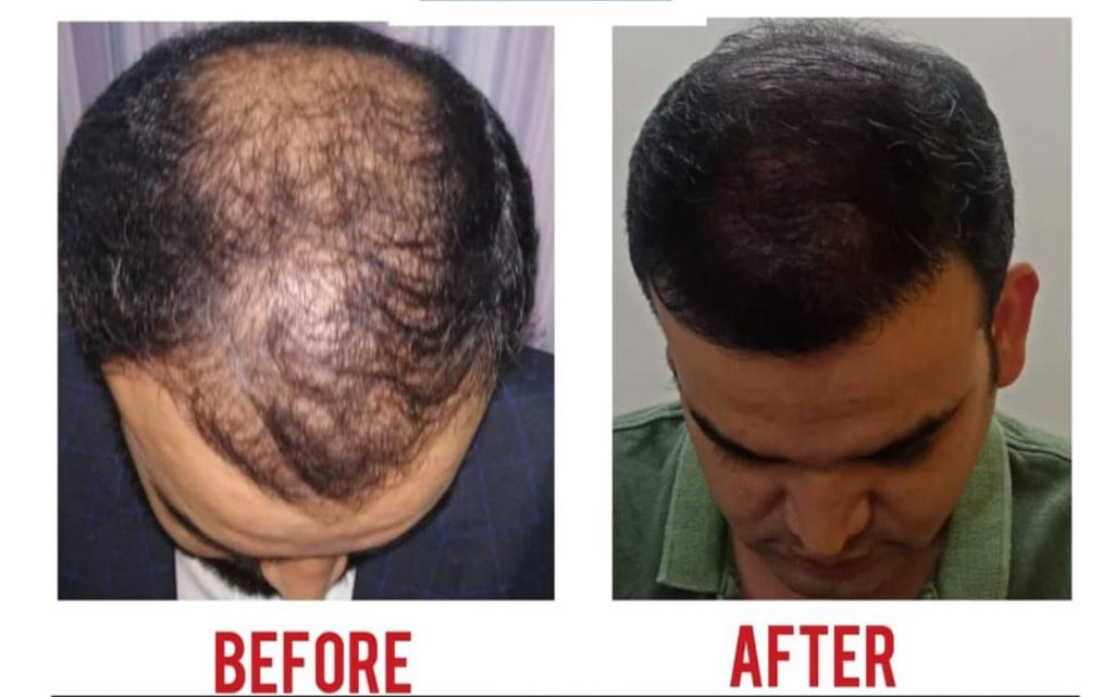This Image tells us about the before and after of a hair transplant treatment