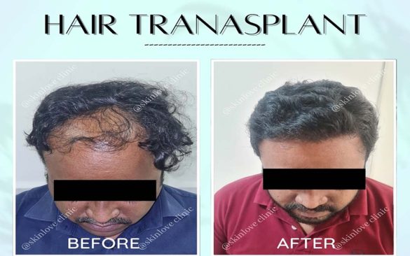 This Image tells us about the before and after of a hair transplant treatment