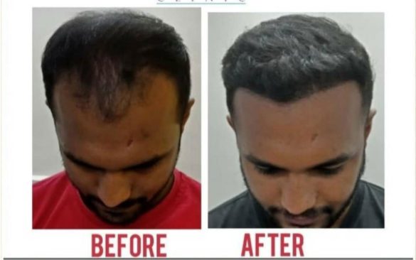 This Image tells us about the before and after of a hair transplant treatment