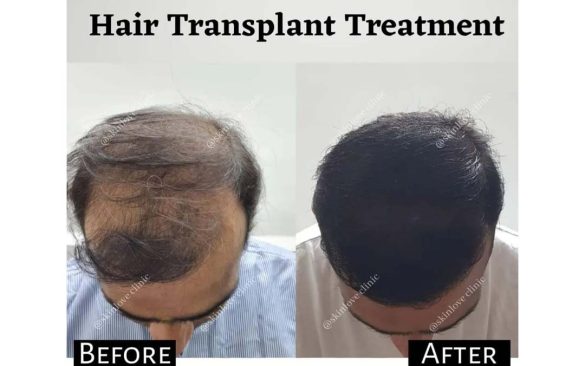 This Image tells us about the before and after of a hair transplant treatment