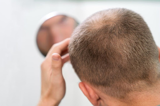 This image is about a man having Hair Loss