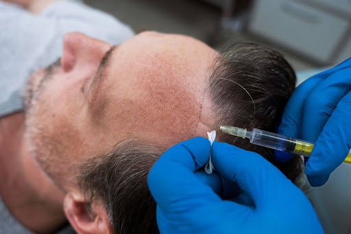 This image is about a man taking PRP Therapy as a hair loss treatment
