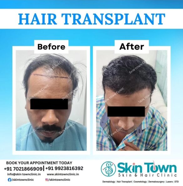 This image is about before and after of a hair transplant surgery