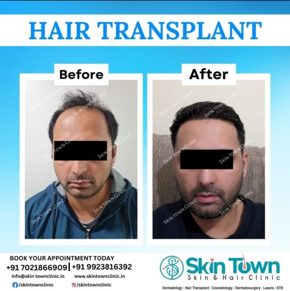 This image is about before and after of a hair transplant surgery