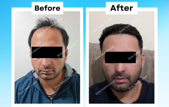 This image is about before and after of a hair transplant surgery