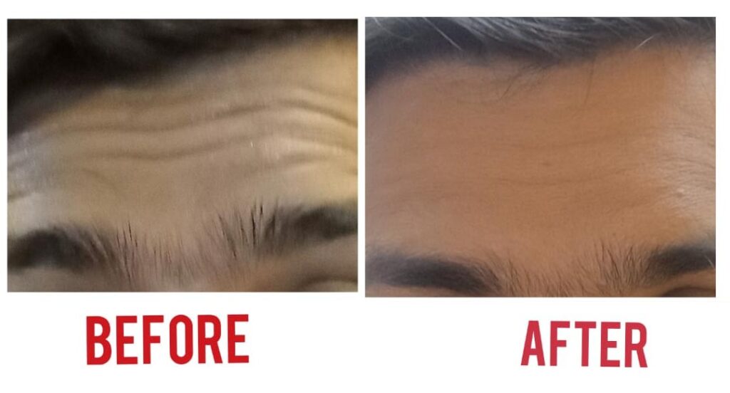 botox treatment for face before and after