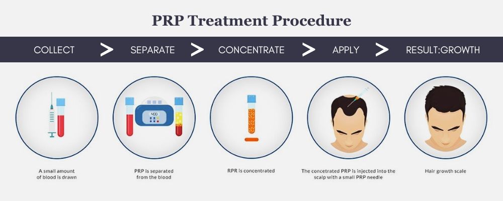 PRP Treatment Procedure