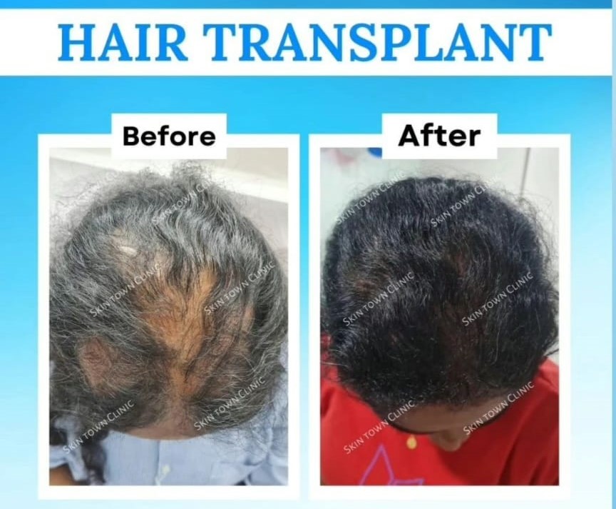 Woman hair transplant