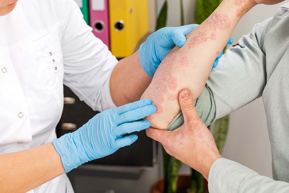 Psoriasis Treatment