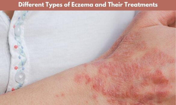 Eczema Specialist in Mumbai