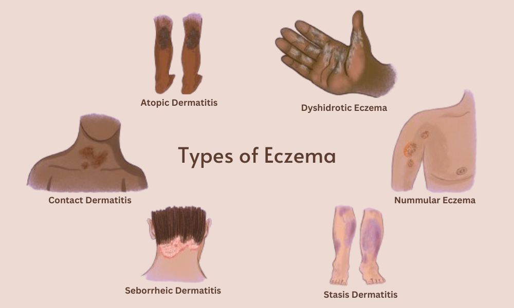 Understanding Eczema The 3 Most Common Types Of Eczema Ayurvedic