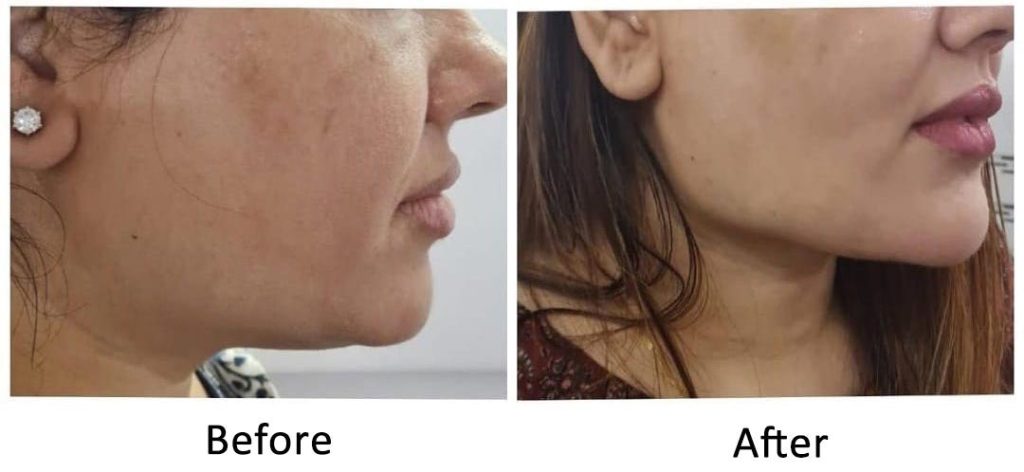 Jawline filler treatment