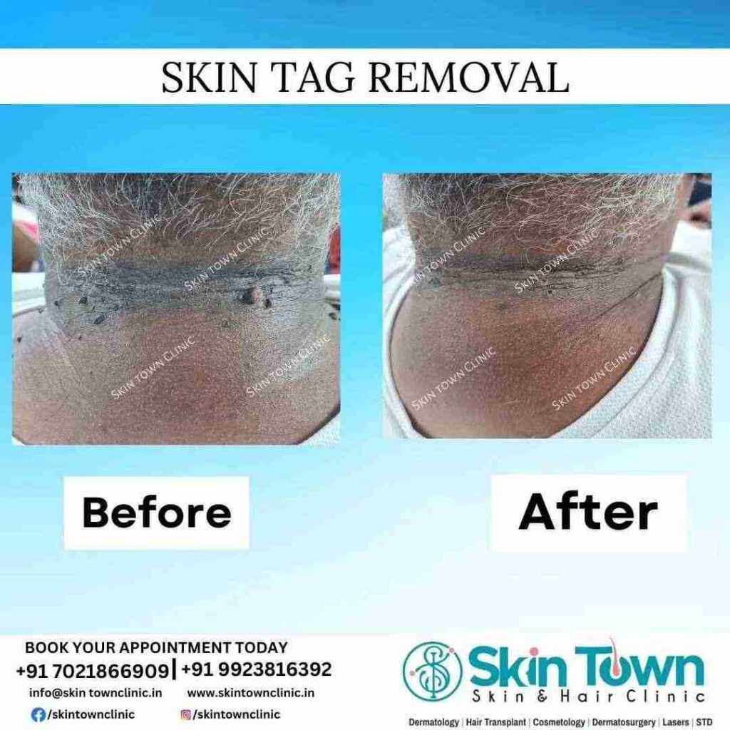 Skin Tag removal in dadar