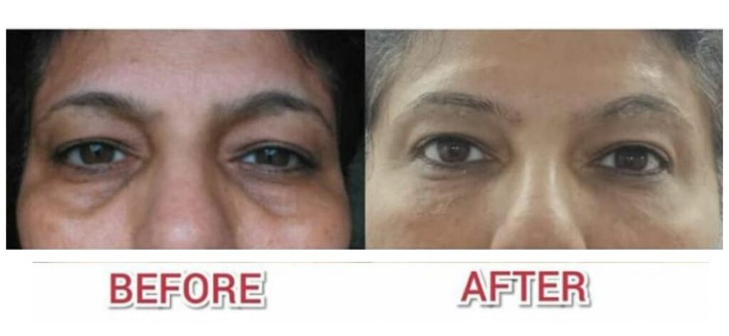 under eye filler treatment