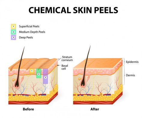 chemical peel before after