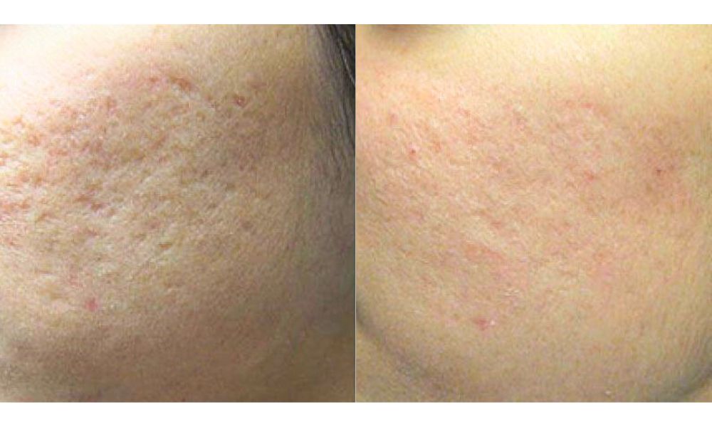 Laser Toning for Acne scars