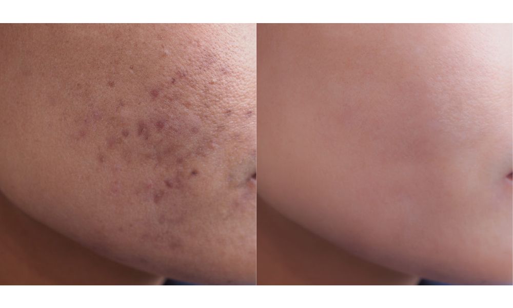 Laser Toning for Dark Spots