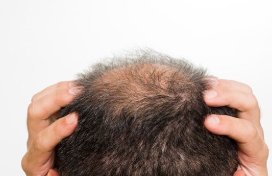 This image is related to hair loss