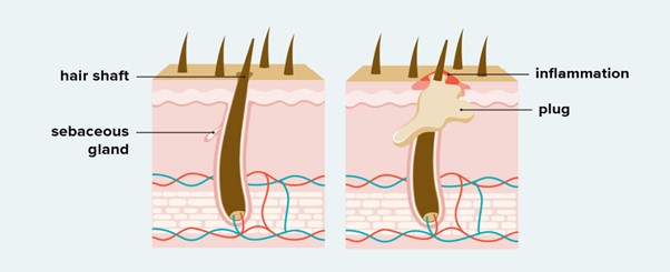 This image is related to the difference between healthy and inflamed hair shaft