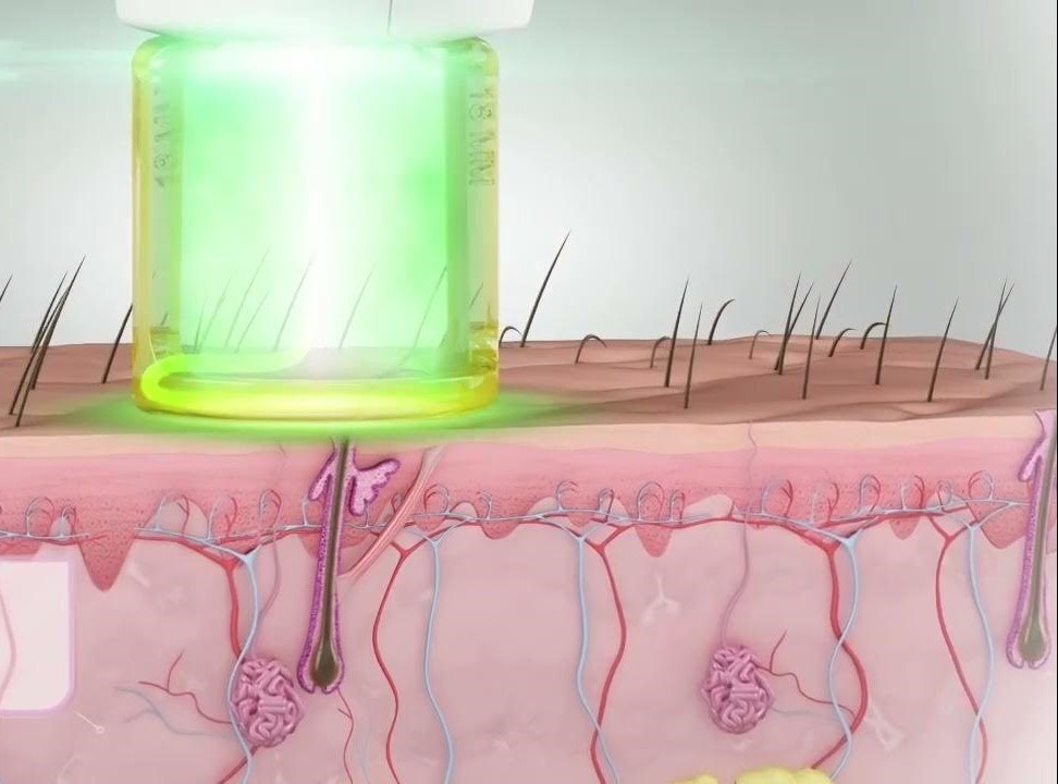 Image shows that how laser treatment is going in detail