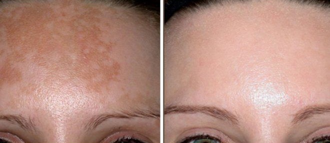 image shows that how pigmentation alma Q treatment works