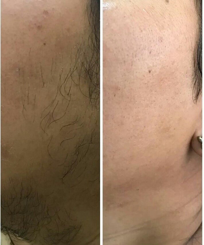 skin transformation of laser hair treatment