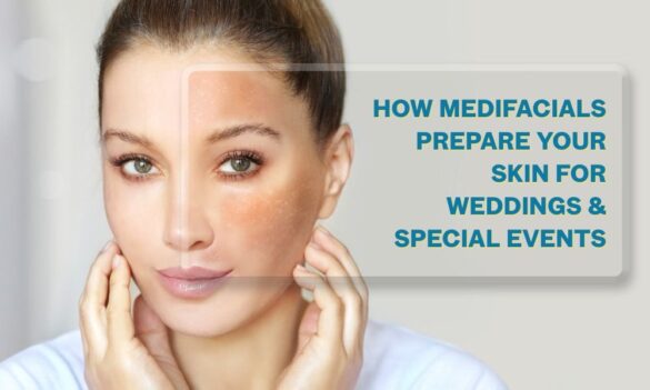 How Medifacials Prepare Your Skin for Weddings & Special Events
