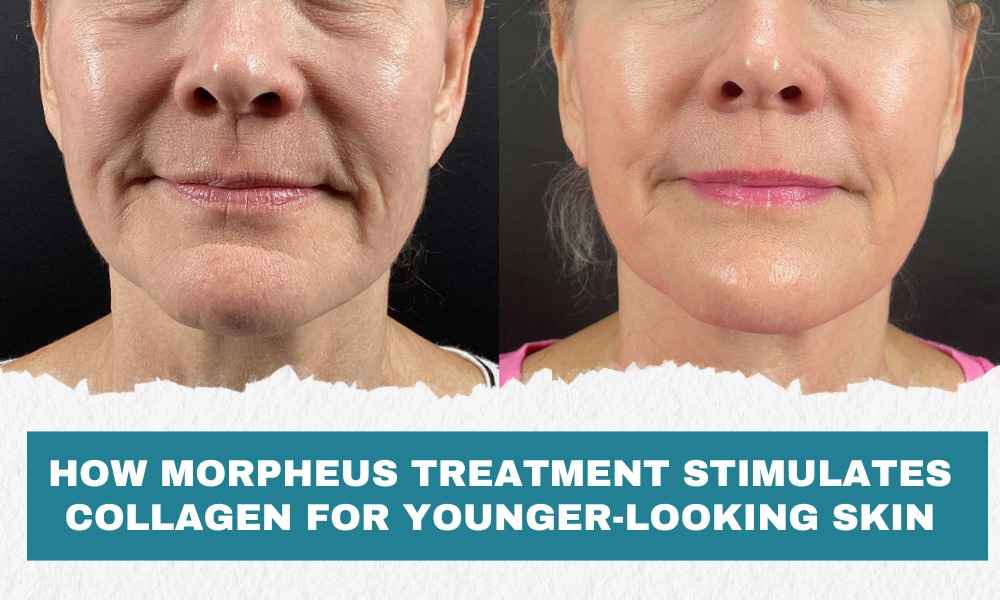How Morpheus Treatment Stimulates Collagen for Younger-Looking Skin