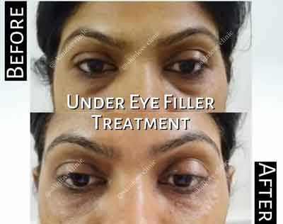 This image shows the before and after of an Under Eye Filler Treatment
