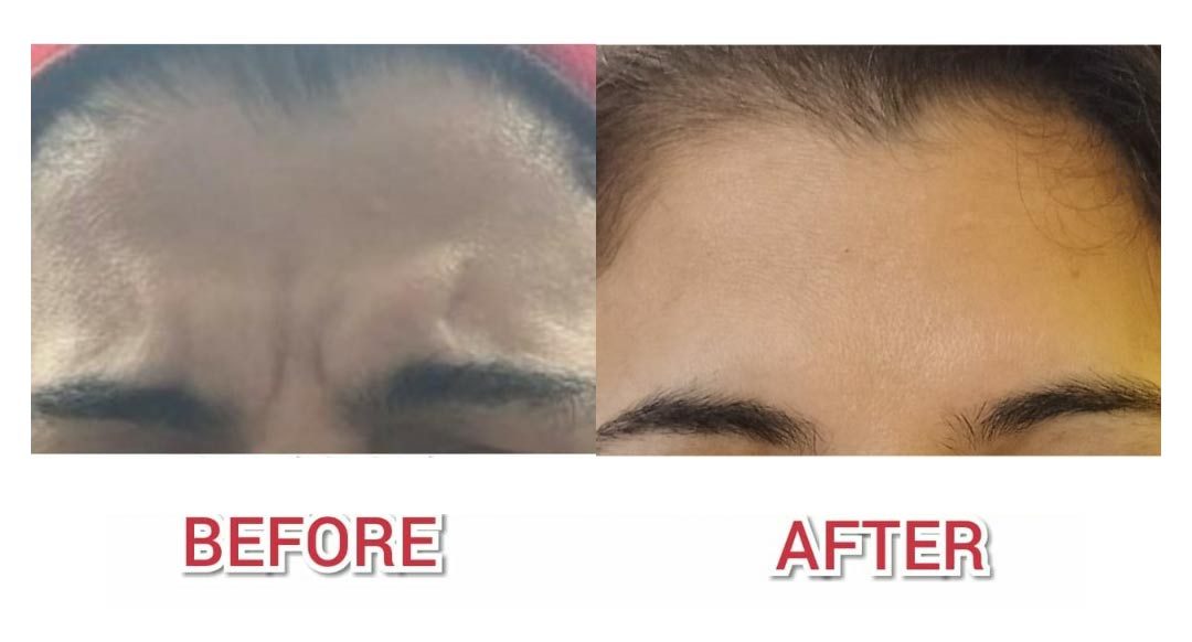 This image is about the before and after of a Face surgery.